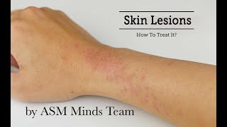 Skin lesions part 1Benign and Premalignant by ASM Minds Team [upl. by Mumford]