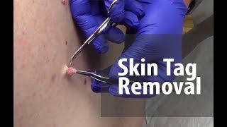 Skin Tag Removal  Dr Derm [upl. by Annola]