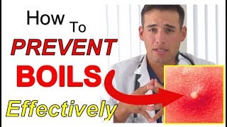 How to PREVENT Boils Effectively 4 STEPS  The Best Way to PREVENT Boils From Coming Back [upl. by Aima]