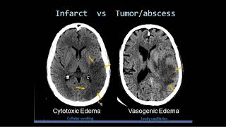 Intro to Head CT Part II Evaluation of Ischemic Stroke [upl. by Ayetal544]