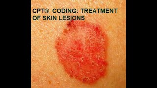 CPT® coding for Skin Lesions [upl. by Giordano]