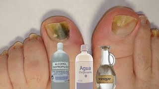 Fabrica tu propio “rompe hongos” natural para las uñas [upl. by Meihar277]