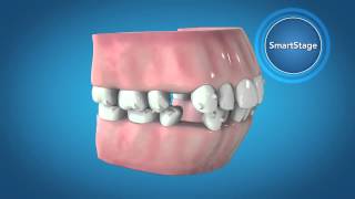 Invisalign G6 Innovations for First Premolar Extraction [upl. by Retnyw]