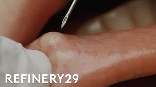 I Got My Botched Lip Filler Popped  Macro Beauty  Refinery29 [upl. by Rairb]