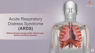 Acute respiratory distress syndrome  ARDS  Etiology Clinical features Diagnosis and Treatment [upl. by Aviva750]