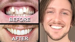 INVISALIGN REVIEW  everything you need to know [upl. by Areem405]