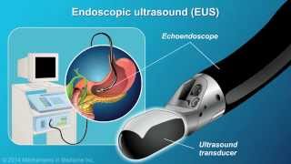 Understanding EUSFNA [upl. by Ratna115]