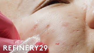 I Got Fillers For My Acne Scars  Macro Beauty  Refinery29 [upl. by Acireh]