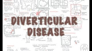 Diverticular Disease diverticulitis  Overview [upl. by Illak]