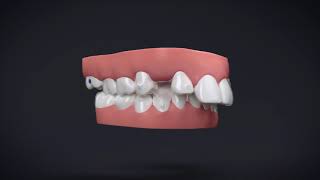 Invisalign® Treatment with Manidublar Advancement [upl. by Chubb]