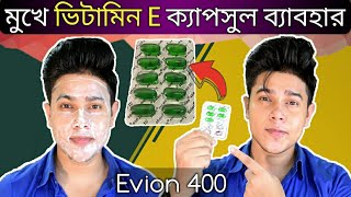 Evion 400 এর সাহায্যে মুখ ফর্সা এবং ব্রণ কমানোর 100  কার্যকরী সহজ উপায়  ভিটামিন ই ক্যাপসুল [upl. by Ameline]