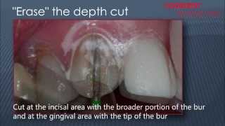 Composite Veneers Preparation [upl. by Notxarb228]