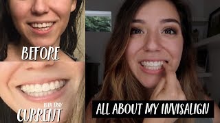 ALL ABOUT MY INVISALIGN  BEFORE amp AFTER PICS COST EXPERIENCE SO FAR [upl. by Catherin311]