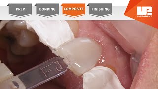 Composite  Your Complete Restorative Solution [upl. by Grinnell245]