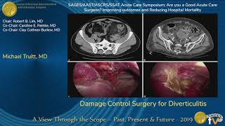 Damage Control Surgery for Diverticulitis [upl. by Eoj962]