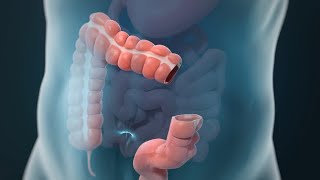 Laparoscopic Colectomy [upl. by Sukhum]