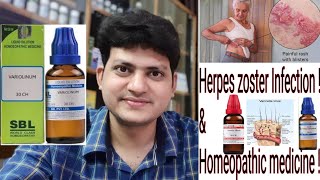 Herpes Zoster  Homeopathic Medicine for Herpes Zoster  Explain [upl. by Rind]