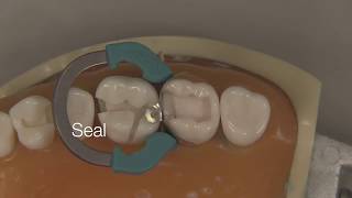 Class II Composite Restoration  Stevenson Dental Solutions [upl. by Nediarb584]