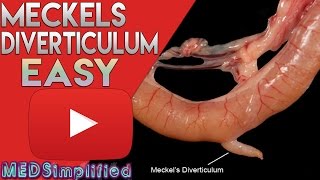 Meckels Diverticulum Made Easy [upl. by Depoliti]