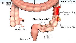 Diverticulitis [upl. by Cobbie846]