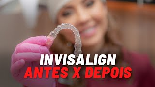 Invisalign  Casos antes e depois [upl. by Anatak]