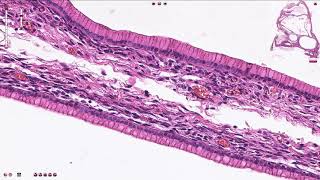 Ovary Mucinous cystadenoma [upl. by Harty160]