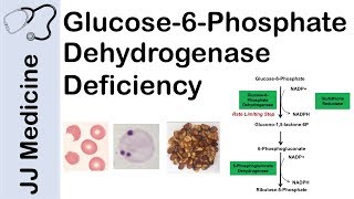 Glucose6Phosphate Dehydrogenase Deficiency  Symptoms Pathophysiology Diagnosis and Treatment [upl. by Tail463]