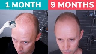 STOP BALDING  Regrow Hair Naturally with Dermaroller Real 9 Month Results [upl. by Cochard]