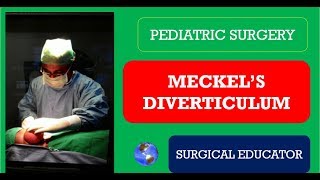 Diverticular Disease  Pathology mini tutorial [upl. by Alel]