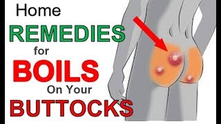 The 3 Most Effective Home REMEDIES for BOILS on BUTTOCKS  Boils BUTTOCKS Treatment for Fast Relief [upl. by Ordway]